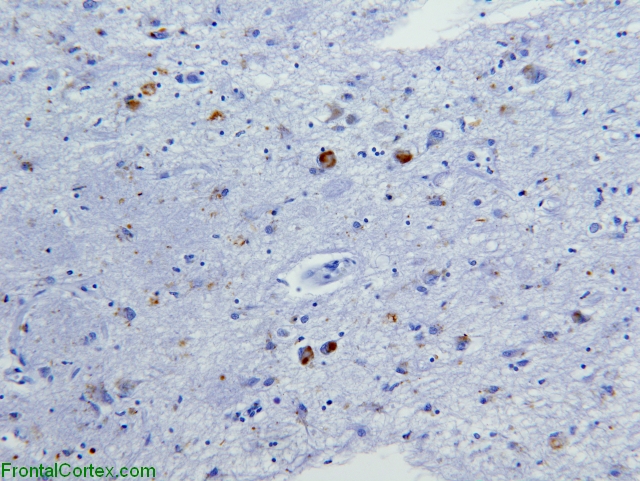Amygdala, immunohistochemical staining for alpha synuclein